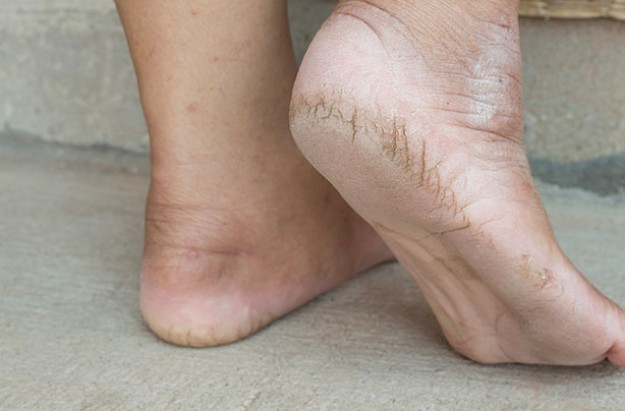vicks vaporub for dry cracked feet
